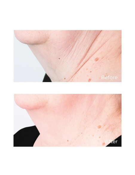 Cold Plasma Plus+ Sub-D/Neck
