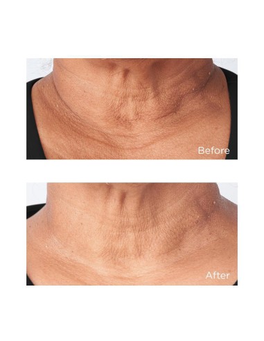 Cold Plasma Plus+ Sub-D/Neck