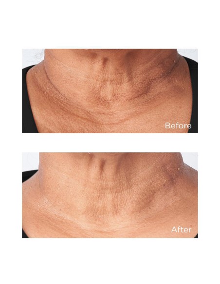 Cold Plasma Plus+ Sub-D/Neck